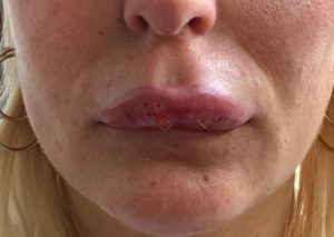 Lippen aufspritzen mit dem Hyaluronpen-schwellung