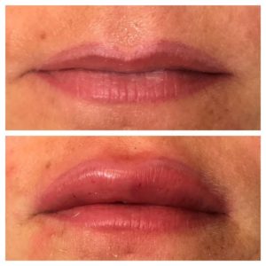 Lippen aufspritzen mit Hyaluron vorher und nachher
