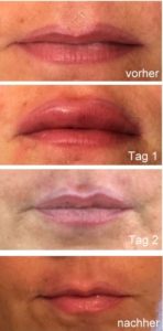 Lippenvergrößerung mit Hyaluron lippen aufspritzen vorher und nachher